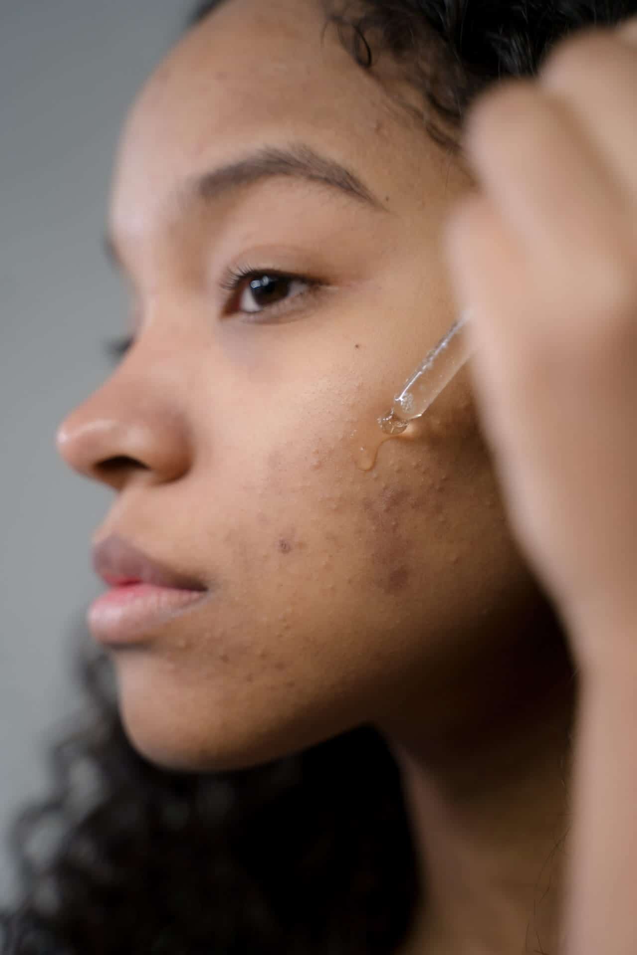 L'image montre une femme appliquant un produit sur son acnée.